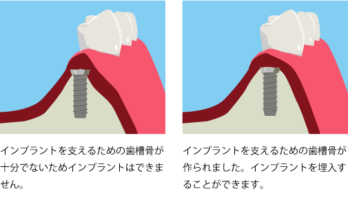 インプラントを支えるための歯槽骨が十分でないためインプラントはできません。インプラントを支えるための歯槽骨が作られました。インプラントを埋入することができます。