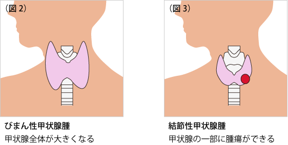 症状 ん 甲状腺 が