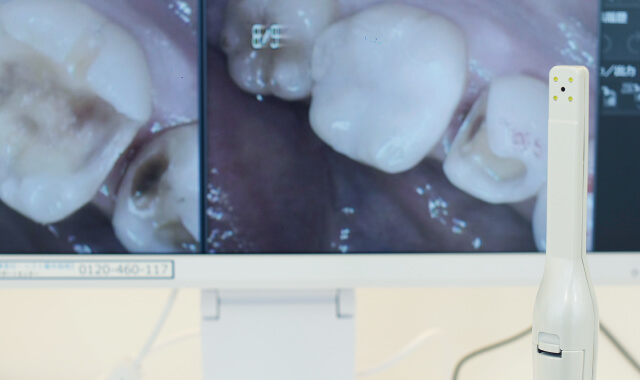歯科用ワイヤレス口腔内カメラ